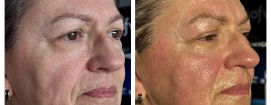 Sofwave Holywoodzki lifting