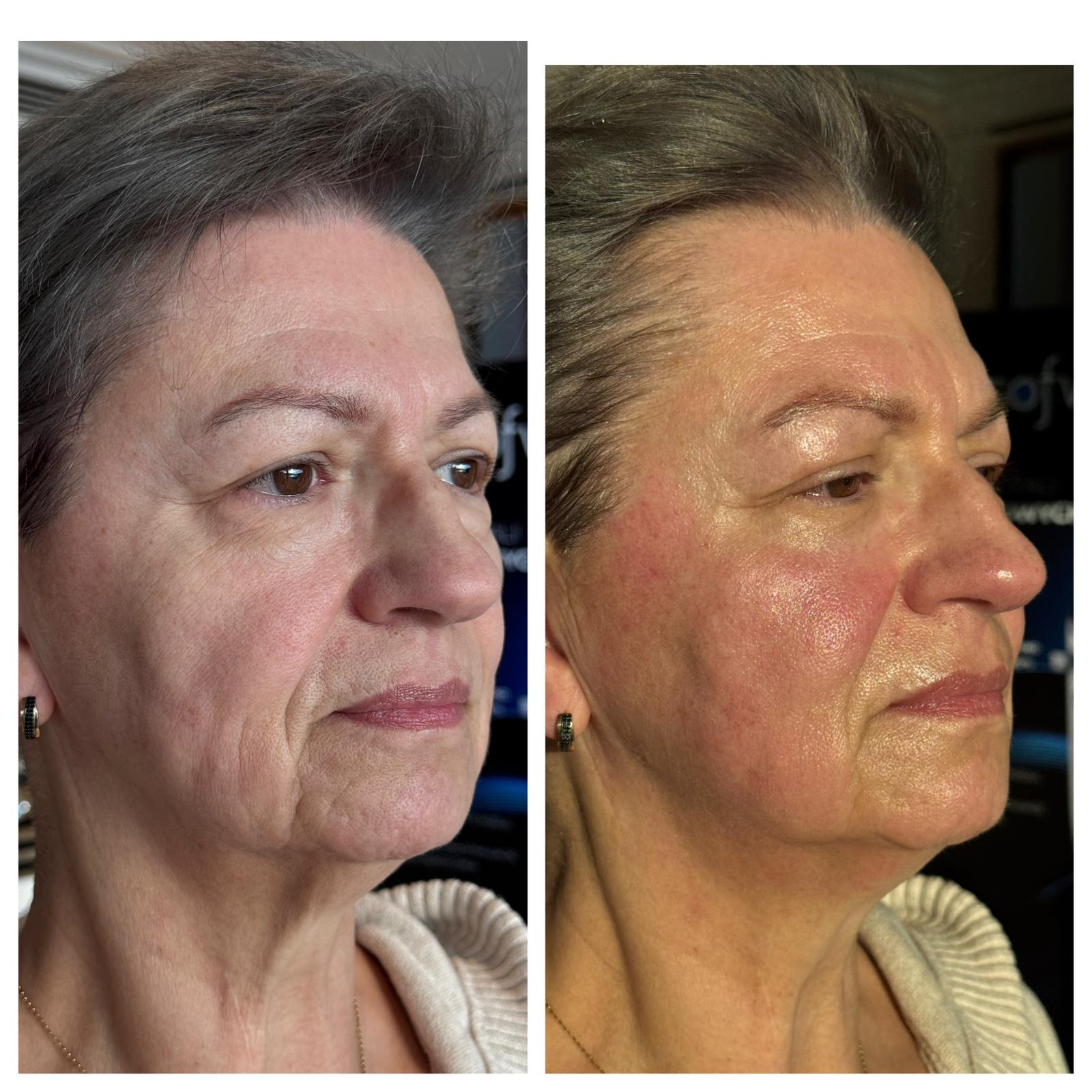 efekty Softwave zabieg USA przed i po