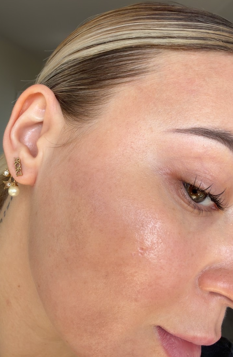 Laser tulowy Gdańsk Holiskin efekt baby face na skórze